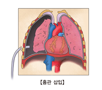 흉관삽입모습